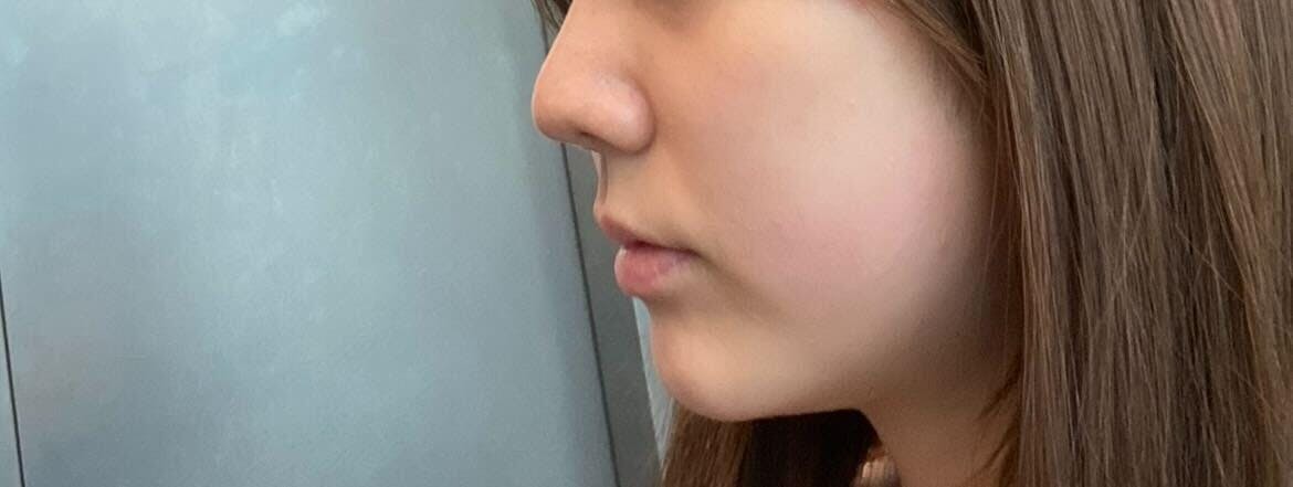 ビアンカ 銀座院(BIANCA)でヒアルロン注射：ヒアルロン酸注入を受けたひよさんの写真