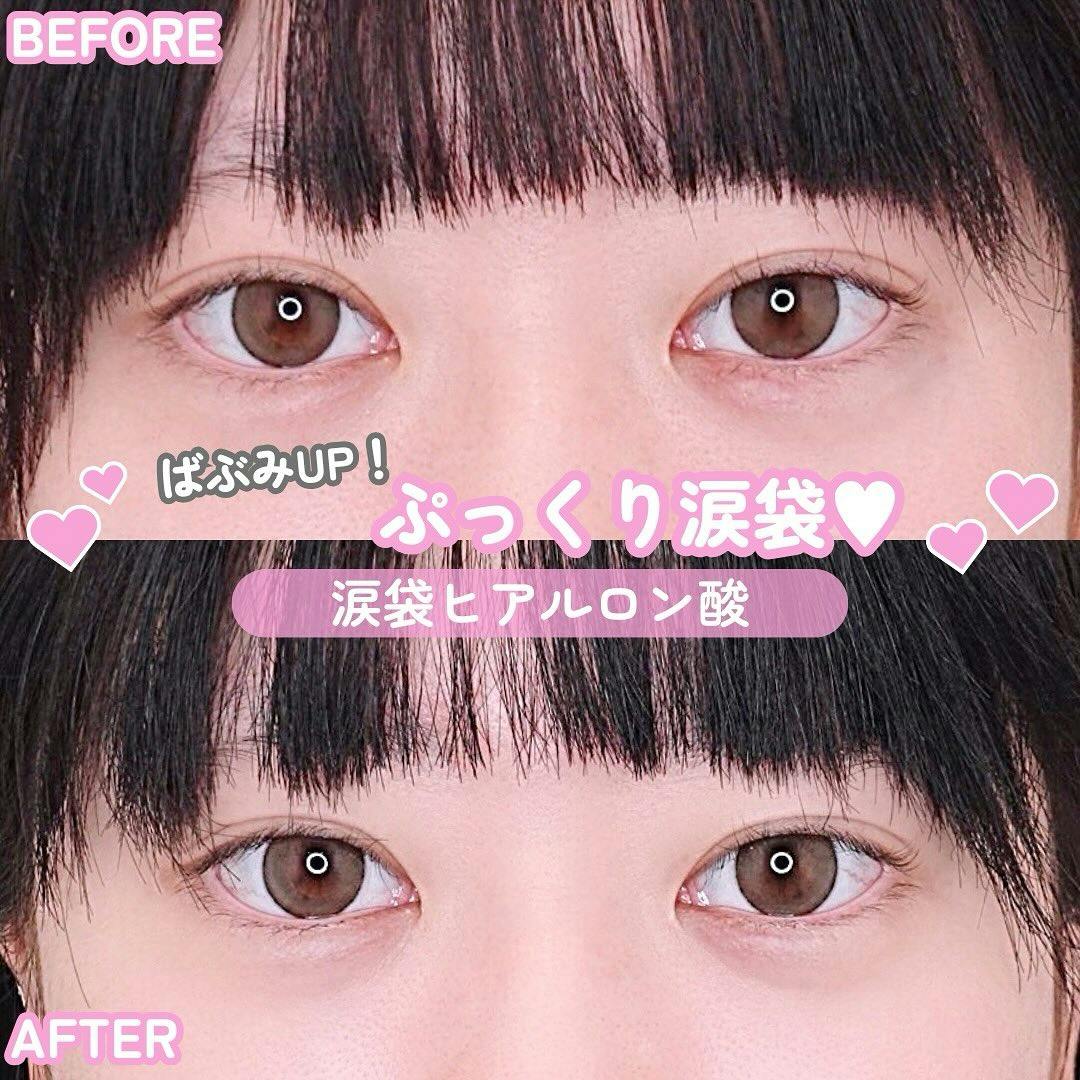 【女性・目】涙袋ヒアルロン酸_before_aftar