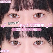 【女性・目】涙袋ヒアルロン酸_before_aftar