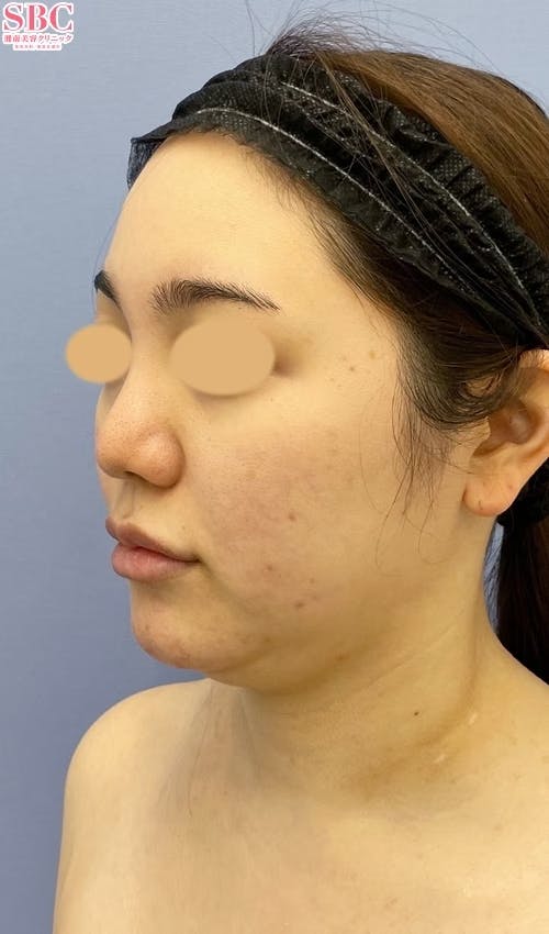 【女性・輪郭】Aquicell（アキーセル）脂肪吸引、メーラーファット除去術、ジョールファット除去術_before