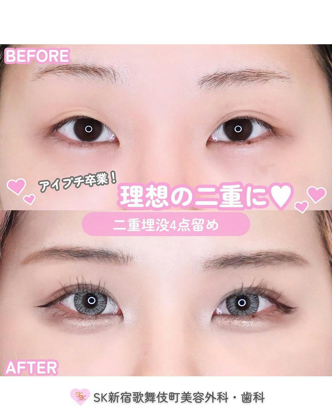 【女性・目元】二重埋没4点留め_before_aftar