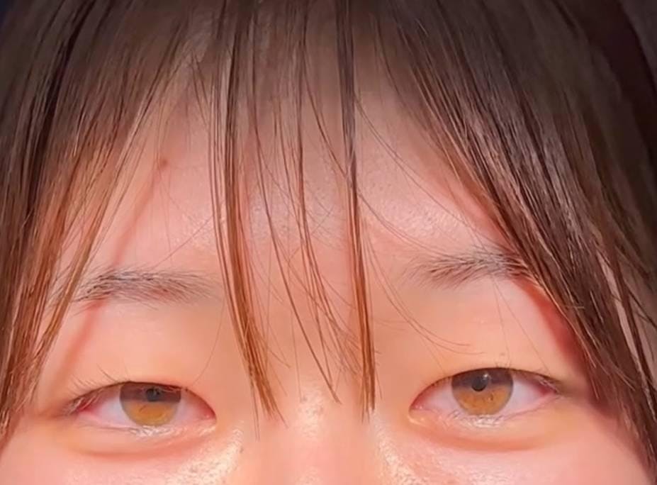 ルラ美容クリニック 渋谷本院で二重埋没法:1dayルラライン二重術を受けた相原さんの写真