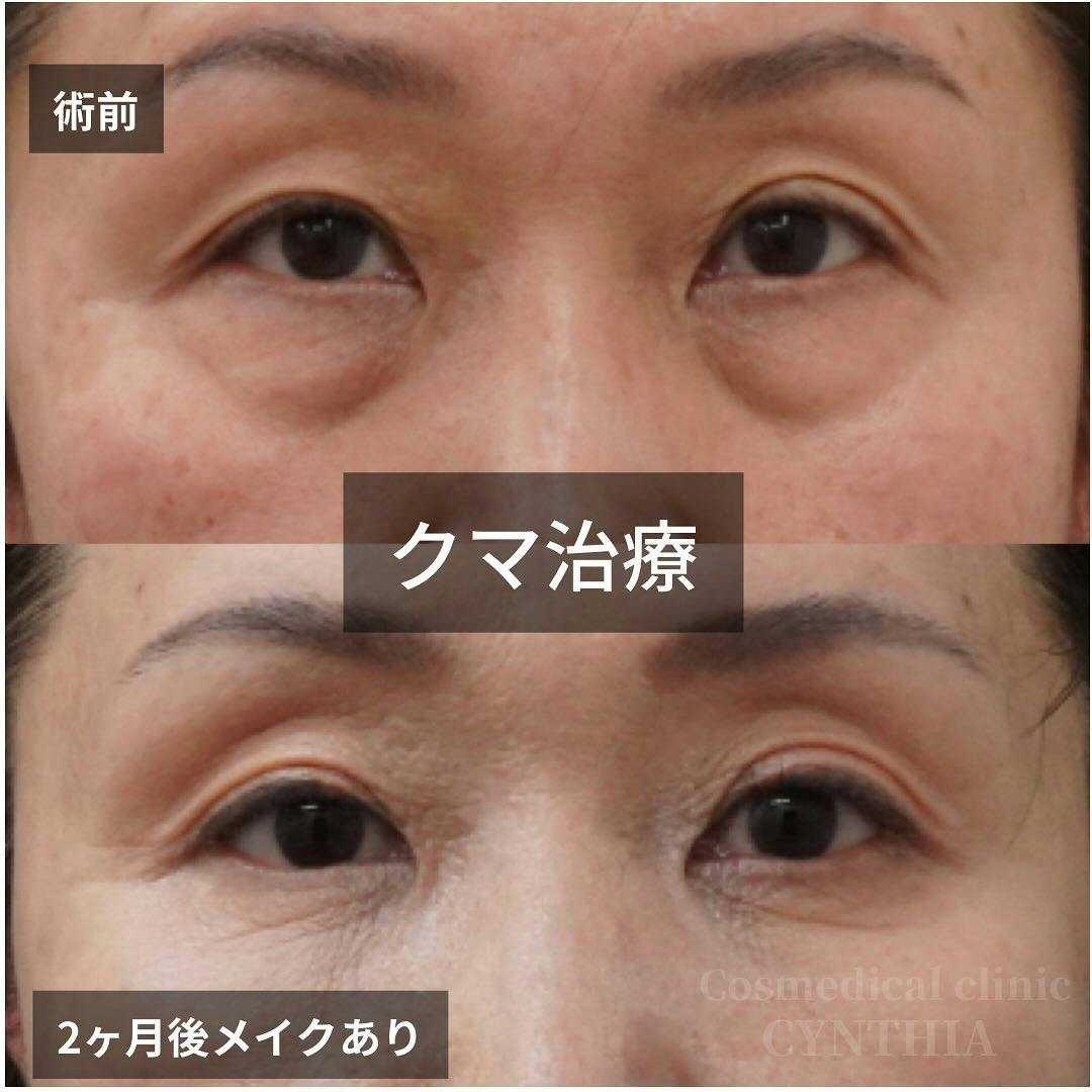 【50代女性・目元】目の下のクマ・たるみ取り_before_aftar