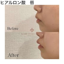 【女性・唇】ヒアルロン酸(唇)_before_aftar