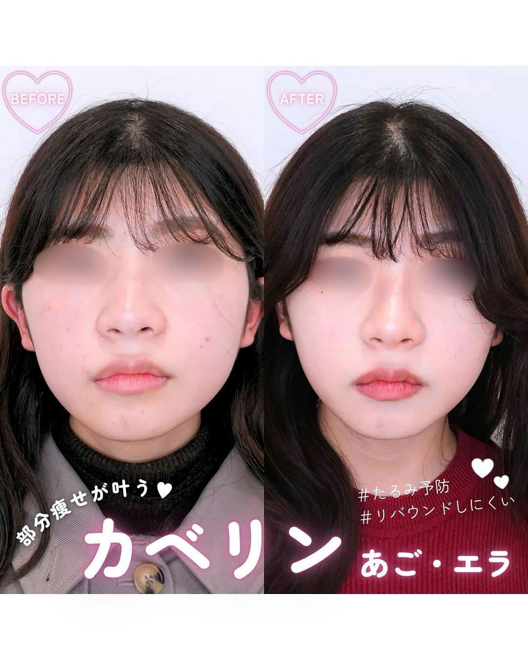 【女性・顔】カベリン あご・エラ_before_aftar