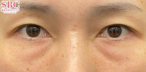 【クマ】目の下の切らないクマ・たるみ（ふくらみ）取り ナチュラル脂肪注射コンデンスリッチ ナチュラル脂肪注射ナノリッチ_before