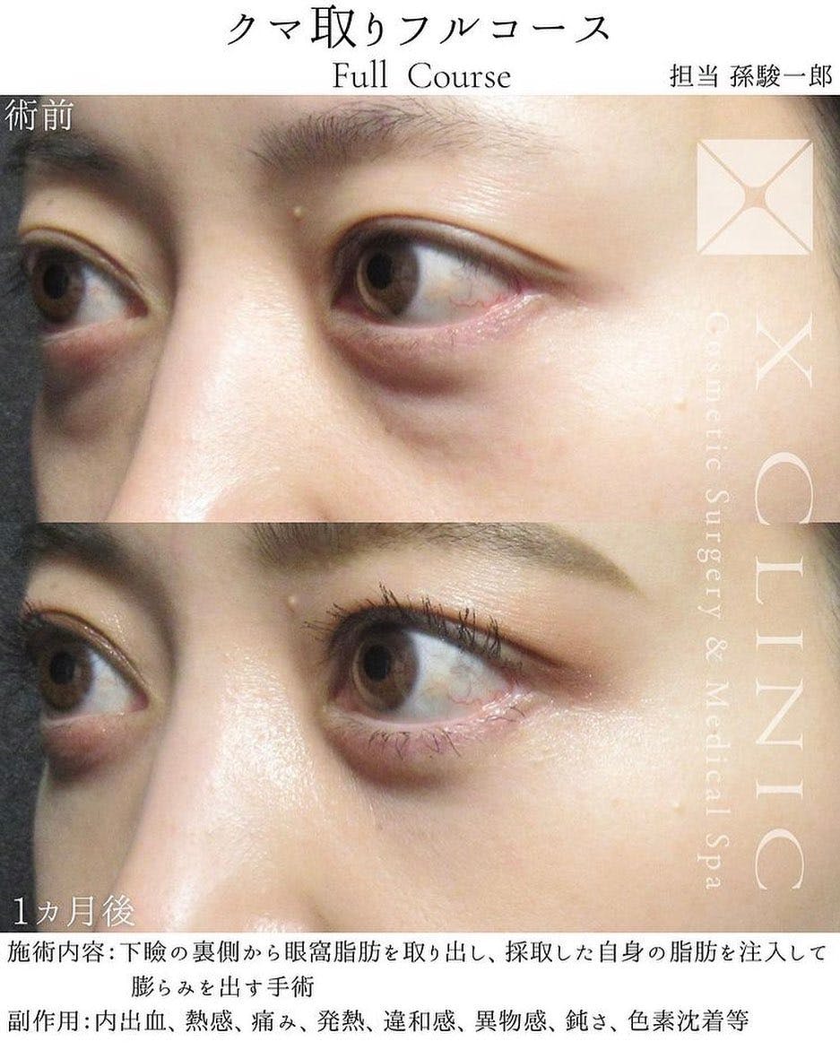 【女性・目元】クマ取りフルコース_before_aftar