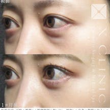 【女性・目元】クマ取りフルコース_before_aftar