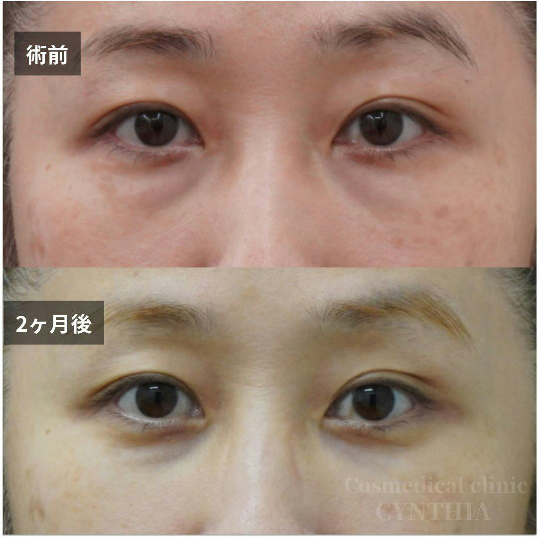 【40代女性・目元】経結膜脱脂術・眼窩脂肪注入_before_aftar
