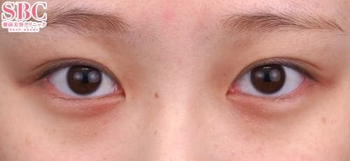 【20代女性・目元】クイックコスメティーク・トリプルNeo_before