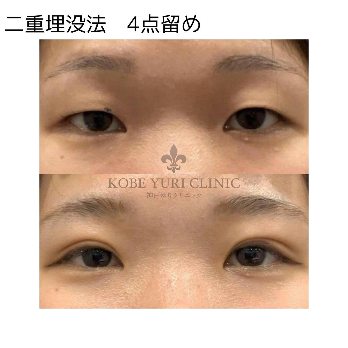 【女性・目元】二重まぶた埋没法4点留め_before_aftar