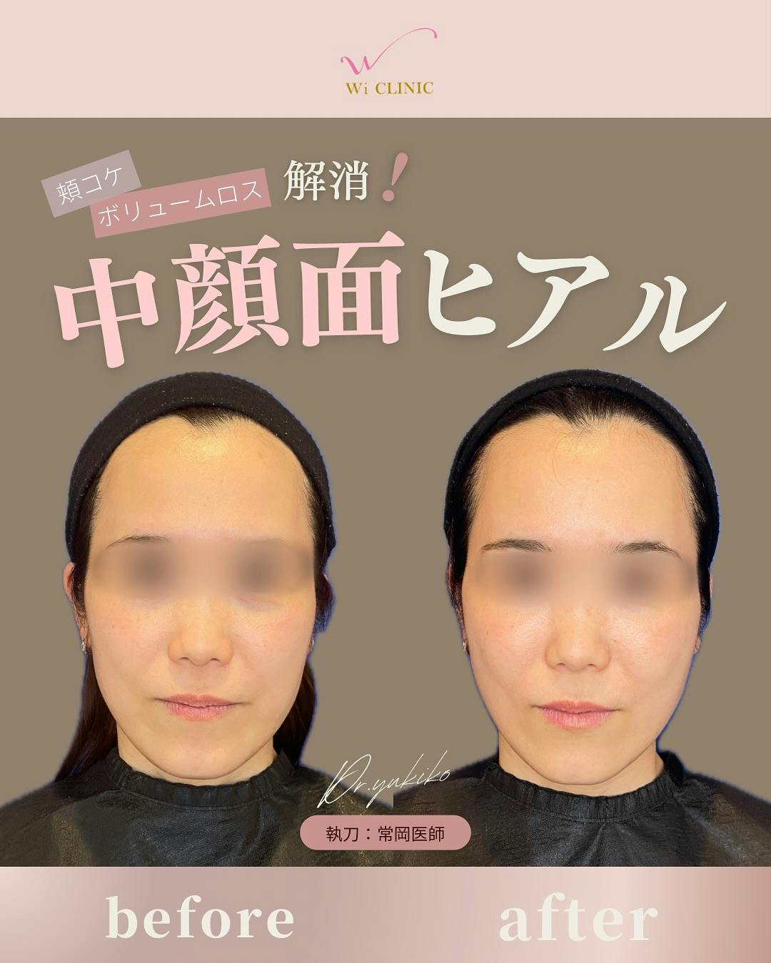 【女性・頬】ヒアルロン酸注入_before_aftar