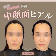 【女性・頬】ヒアルロン酸注入_before_aftar