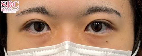 【20代男性・目元】週末二重(R)_aftar