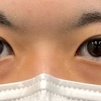 【20代男性・目元】週末二重(R)_aftar
