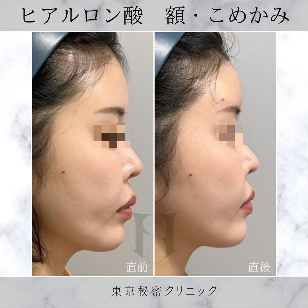 【女性・額】ヒアルロン酸（額・こめかみ）_before_aftar