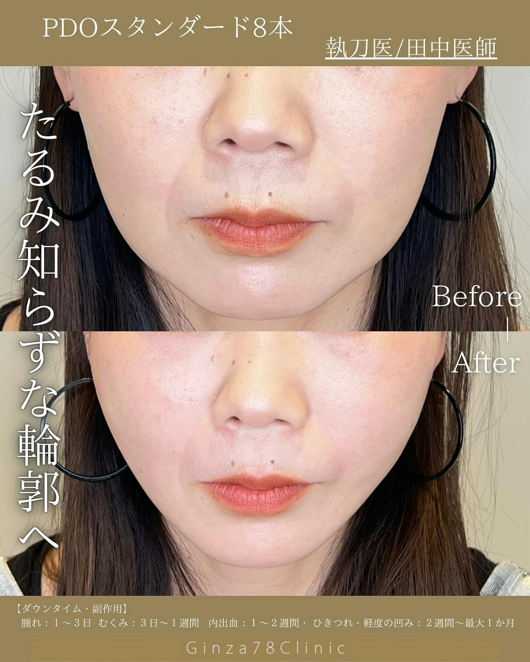 糸リフト(PDOスタンダード)_before_after