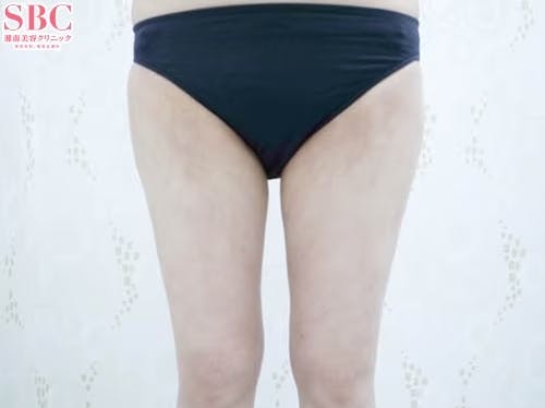 【女性・根こそぎVASER脂肪吸引、ライポマティック脂肪吸引、Aquicell（アキーセル）脂肪吸引】糸リフト_aftar