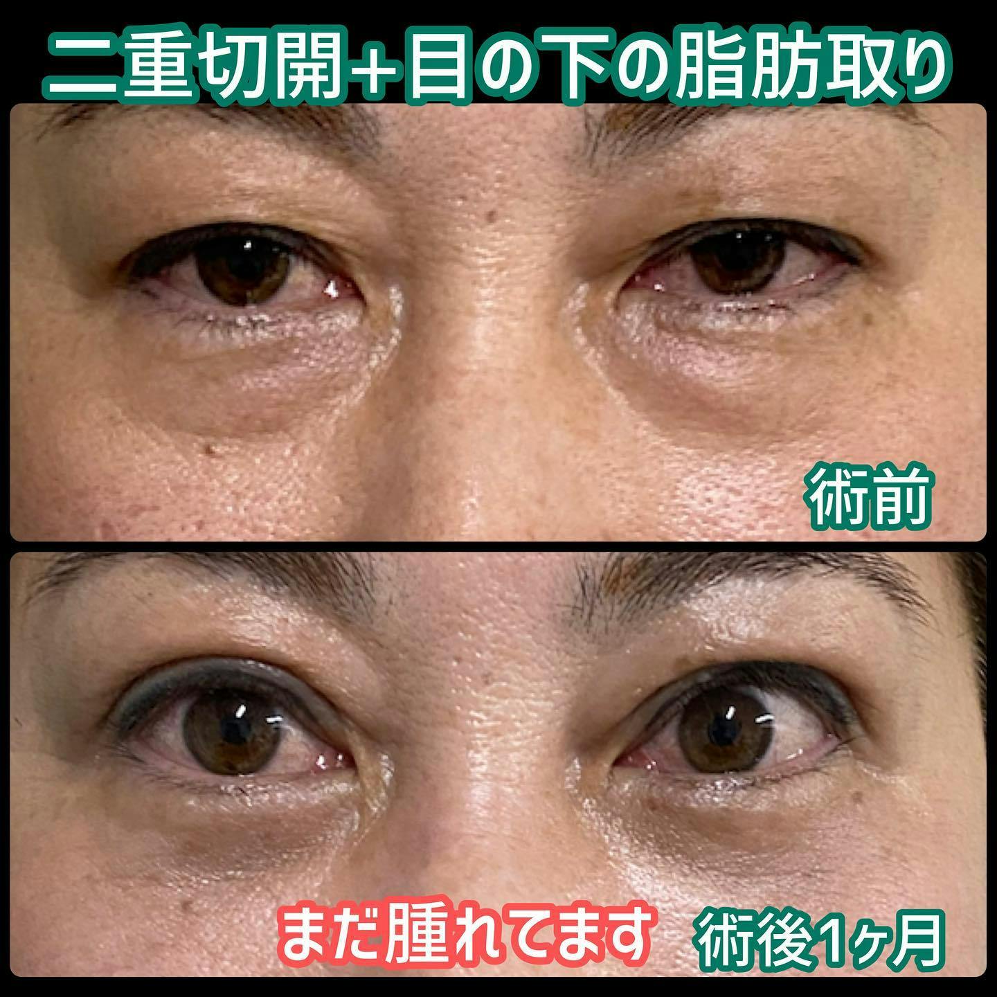 【目元】二重切開＋目の下の脂肪取り_before_aftar