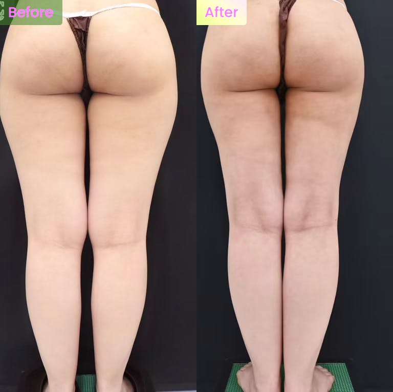 脂肪吸引・お尻の脂肪吸引・太ももの脂肪吸引・膝の脂肪吸引・ベイザー