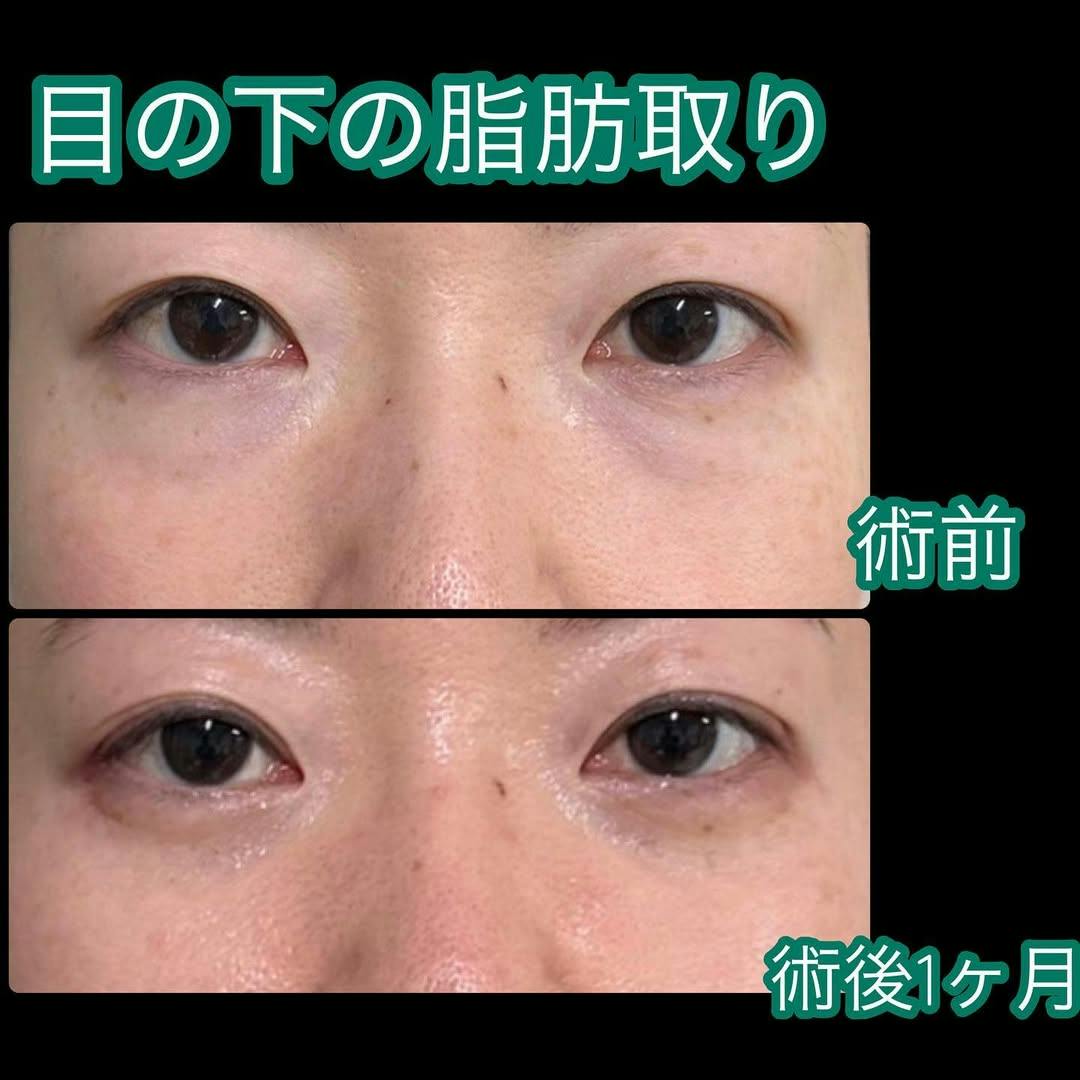 【女性・クマ】目の下の脂肪取り術_before_aftar