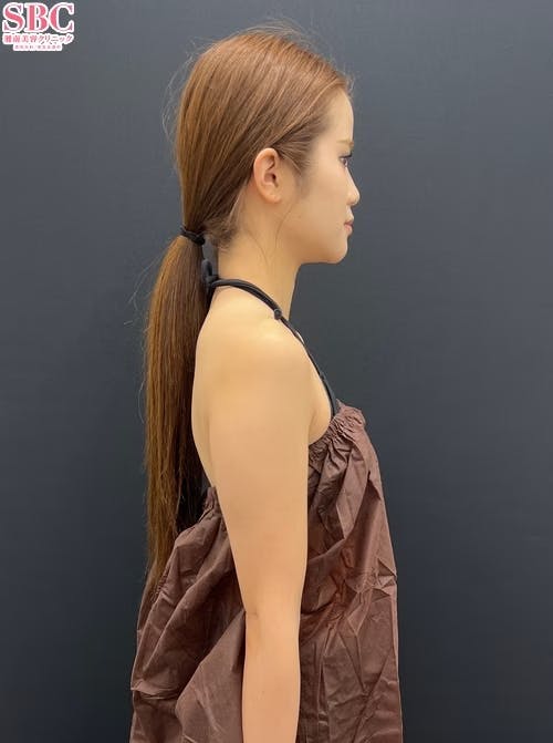 【女性・二の腕】Aquicell（アキーセル）脂肪吸引_before