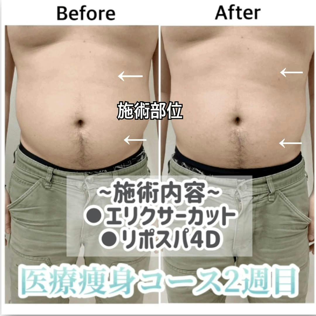 【男性・腹部】医療痩身ゴールドコース（エリクサーカット、リポスパ4D）_before_aftar