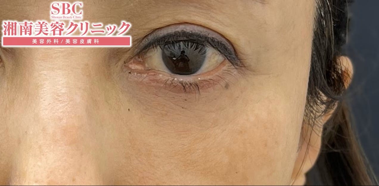 【60代女性・目元】アイバックリムーブ法、ナチュラル脂肪注射コンデンスリッチ、女優注射(R)~リジュラン＋ボトックス_after