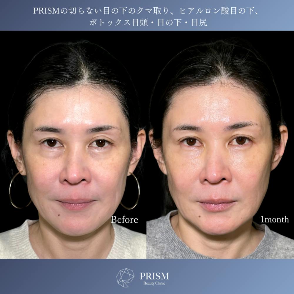 【40代女性・目】切らない目の下のクマ取り＋ヒアルロン酸（目の下）＋ボトックス注射（目頭・目の下・目尻）_before_aftar