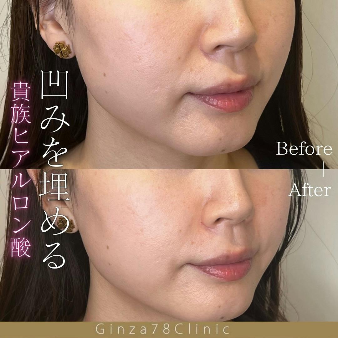 ヒアルロン酸注射・注入・ニューラミス・ジュビダーム(ヒアルロン酸