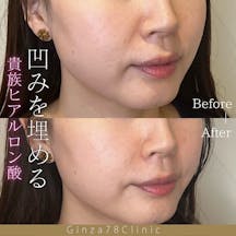 【女性・美肌】ヒアルロン酸_before_aftar