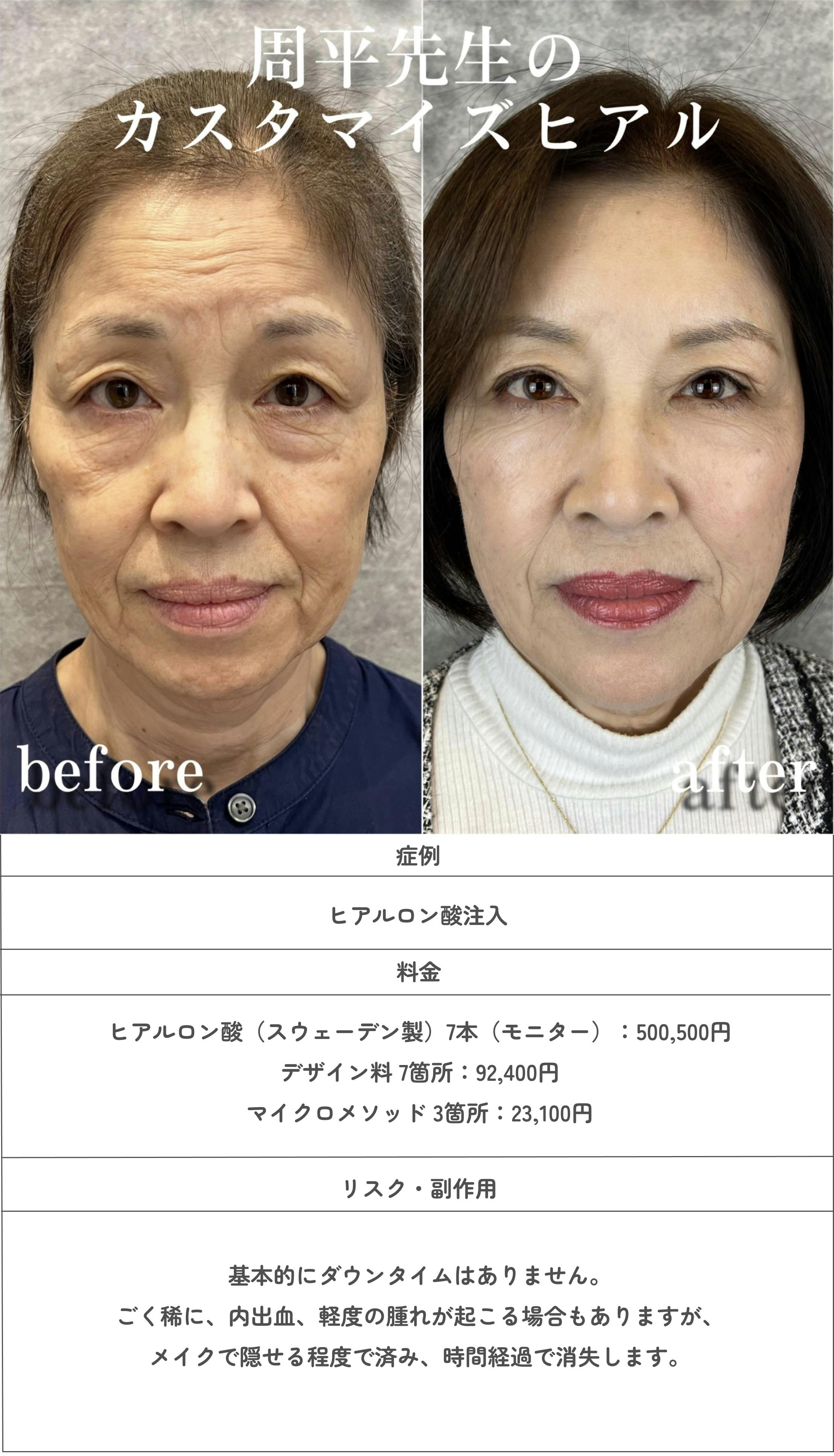 ヒアルロン酸注入は、医師のセンスや技術次第で自然な仕上がりを目指せ