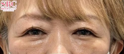 【50代女性・目元】目の下の切らないクマ・たるみ（ふくらみ）取り_after