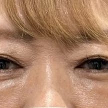 【50代女性・目元】目の下の切らないクマ・たるみ(ふくらみ)取り_after