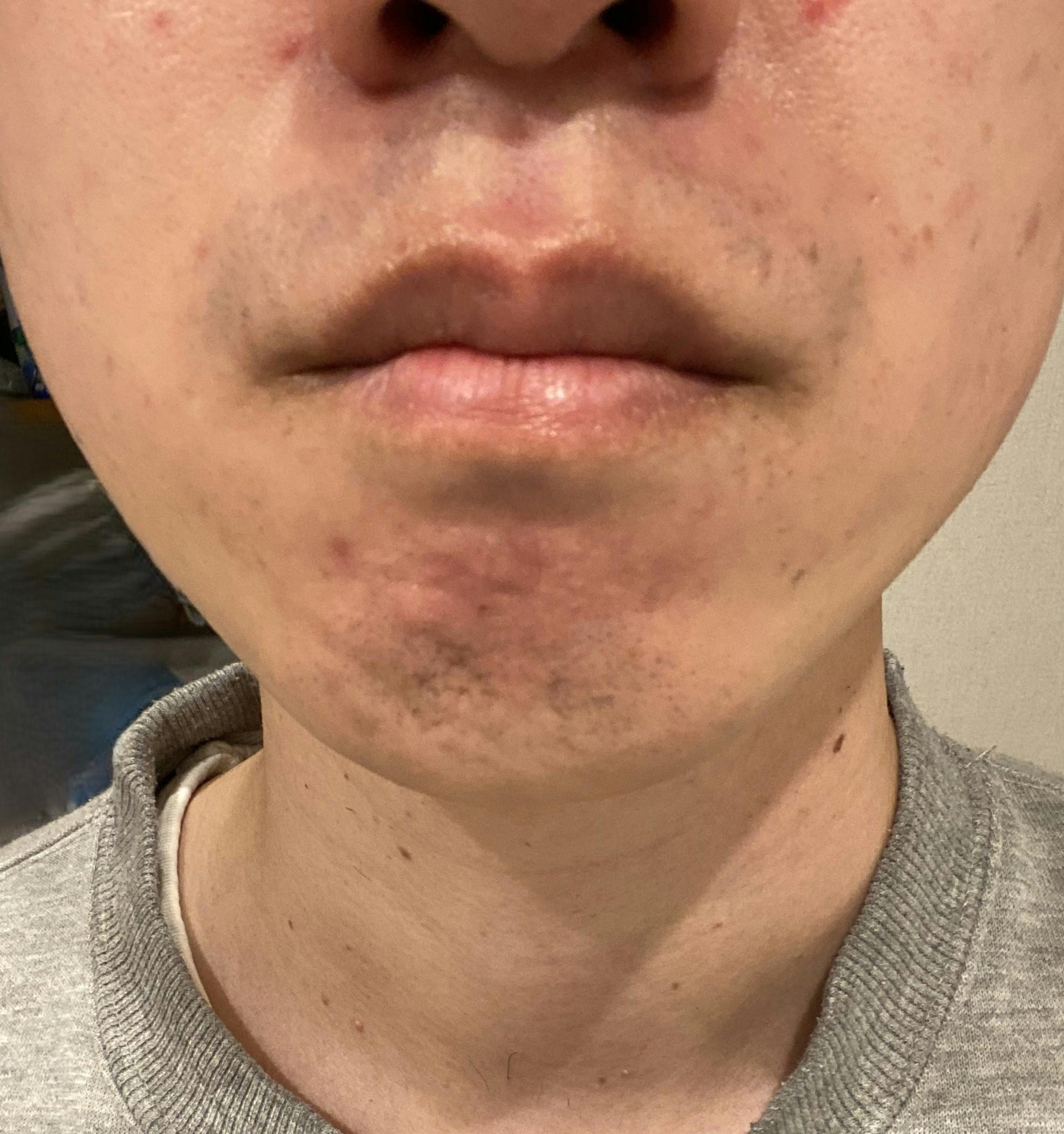 湘南美容クリニック 甲府院でメンズ医療脱毛(鼻下)・メンズ医療脱毛(顎下・首)・メンズ医療脱毛(顎)を受けたguruguruさんの写真