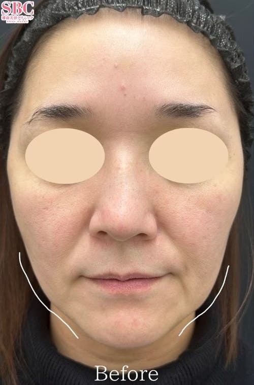 【40代女性・たるみ】シークレットリフト・VOV（ボブ）リフト・ヒアルロン酸ジュビダームビスタ バイクロスシリーズ_before