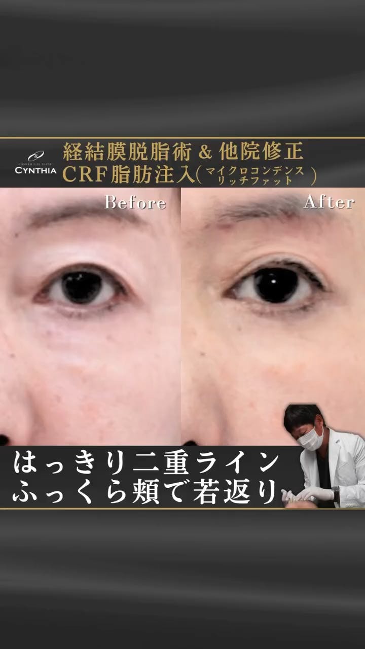 【女性・目元】経結膜脱脂術・マイクロコンデンスリッチファット(CRF)_before_aftar