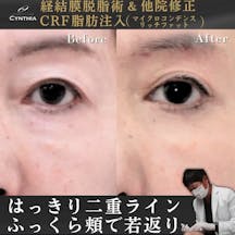 【女性・目元】経結膜脱脂術・マイクロコンデンスリッチファット(CRF)_before_aftar