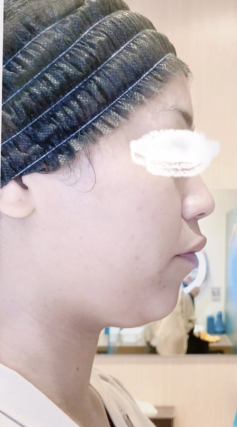 湘南美容クリニック Regno銀座院で顎ボトックスアラガンを受けたマカロンさんの写真