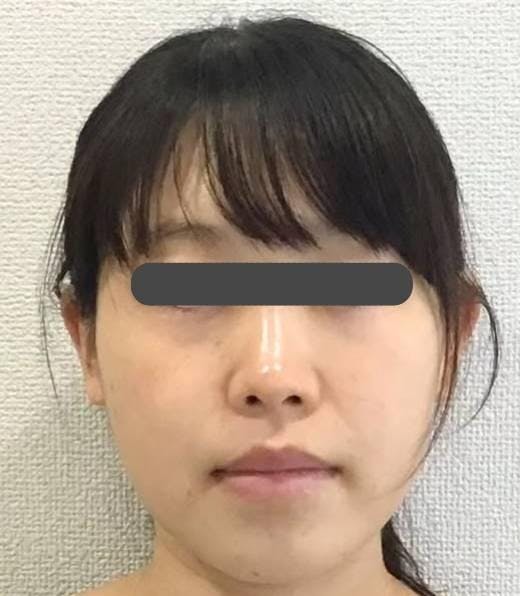 聖心美容クリニック 六本木院で輪郭注射：輪郭注射（頬・顎下）を受けたマイマイマイさんの写真