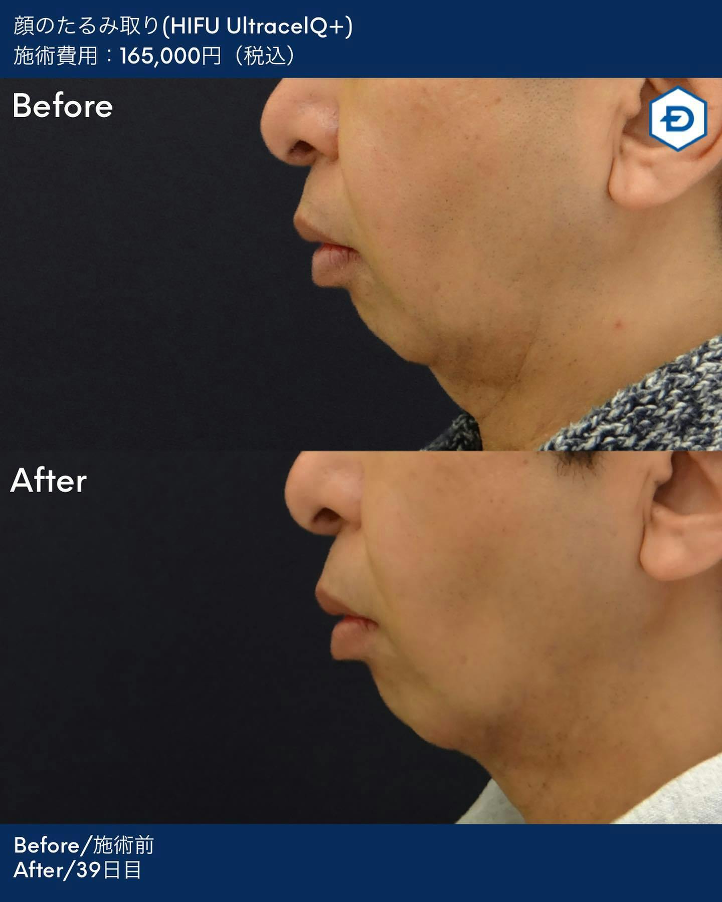 【男性・輪郭】顔のたるみ取り(HIFU UltracelQ+)_before_aftar