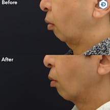 【男性・輪郭】顔のたるみ取り(HIFU UltracelQ+)_before_aftar