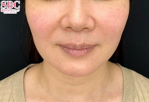 【女性・たるみ】シークレットリフト、プリマリフト、テスリフト_before