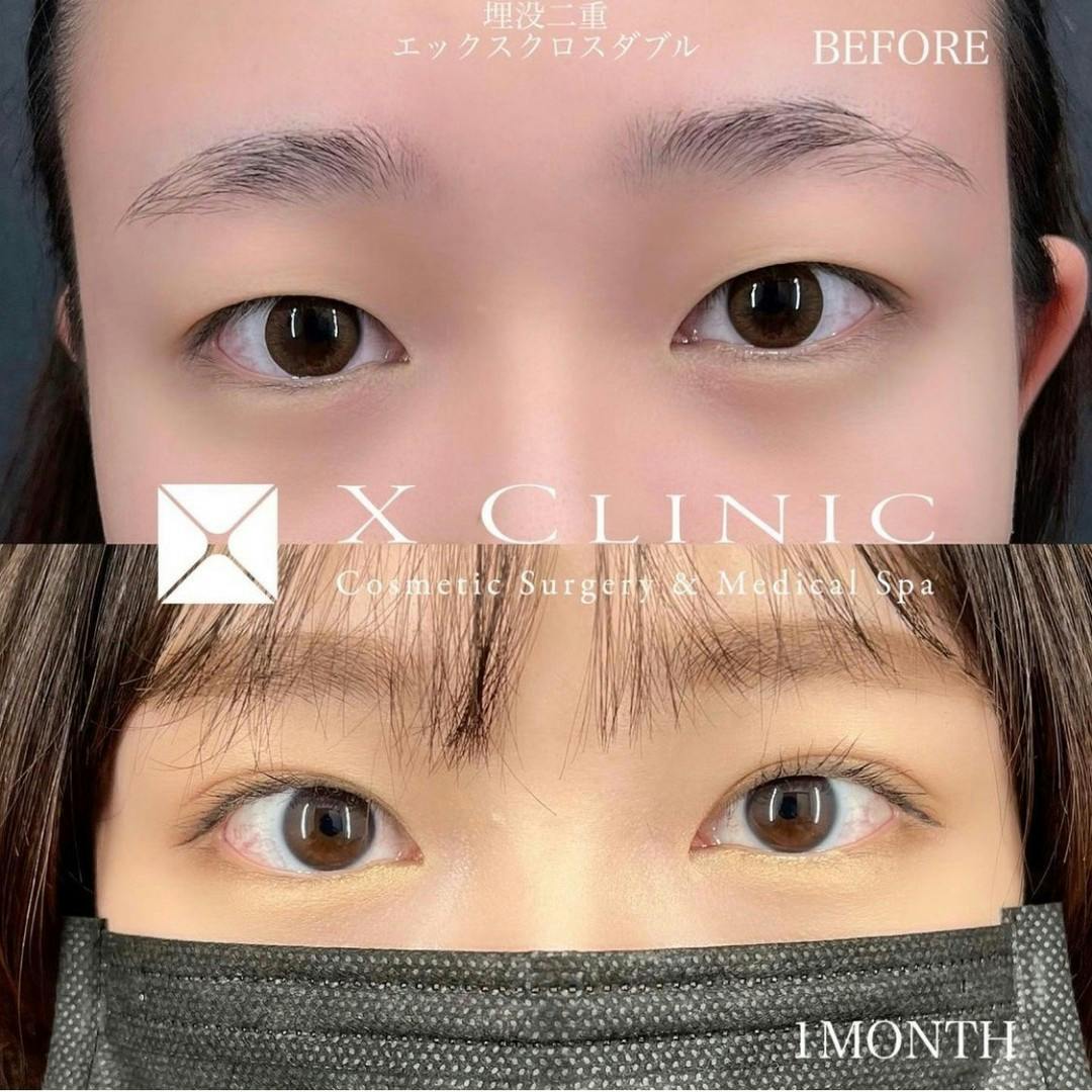 【女性・目元】Xクロスダブル(埋没二重)_before_aftar