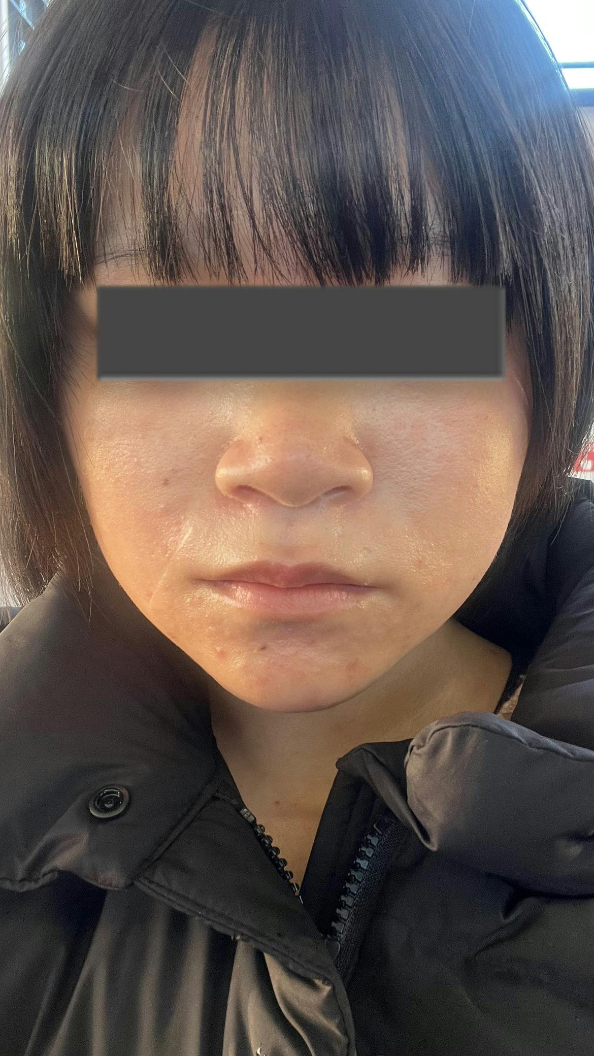 おおたかの森皮フ科で口角ボトックス、サリチル酸ピーリング、医療脱毛(VIO)を受けたゆかさんの写真