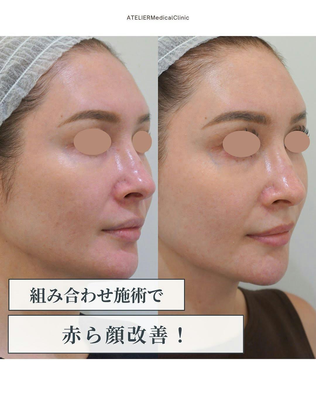 【女性・赤み】ジェネシスのレーザー_before_aftar