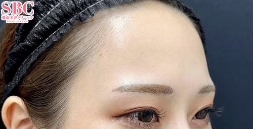 【20代女性・額・こめかみ】コンデンスリッチフェイス法(額・こめかみ脂肪注入)・ナチュラル脂肪注射・ナチュラル脂肪注射コンデンスリッチ_before