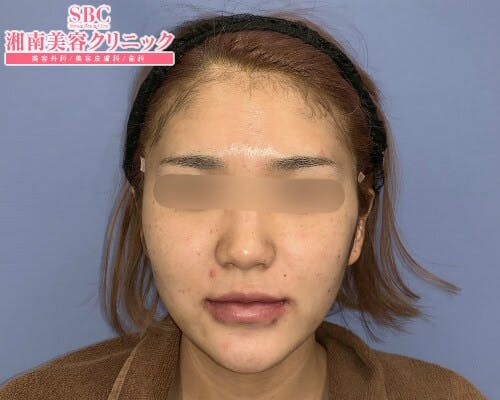 【女性・輪郭】シークレットリフト、ヒアルロン酸ジュビダームビスタ バイクロスシリーズ_aftar