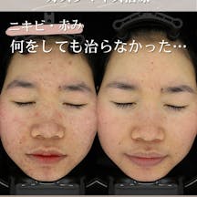 【20代女性・ニキビ】クロモライト・イソトロイン・ACRS_before_aftar