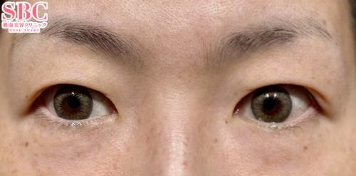 【40代女性・目元】週末二重(R)_before